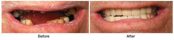 Before and after partial denture treatment